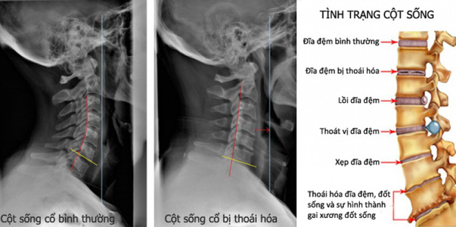 Triệu chứng thoái hóa đốt sống cổ