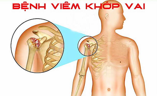 Viêm quanh khớp vai và những điều bạn chưa biết