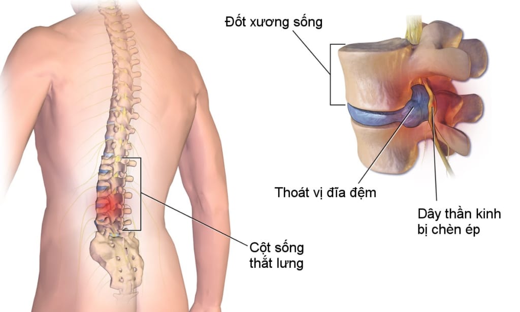 Tìm hiểu về căn bệnh thoái hóa cột sống thắt lưng