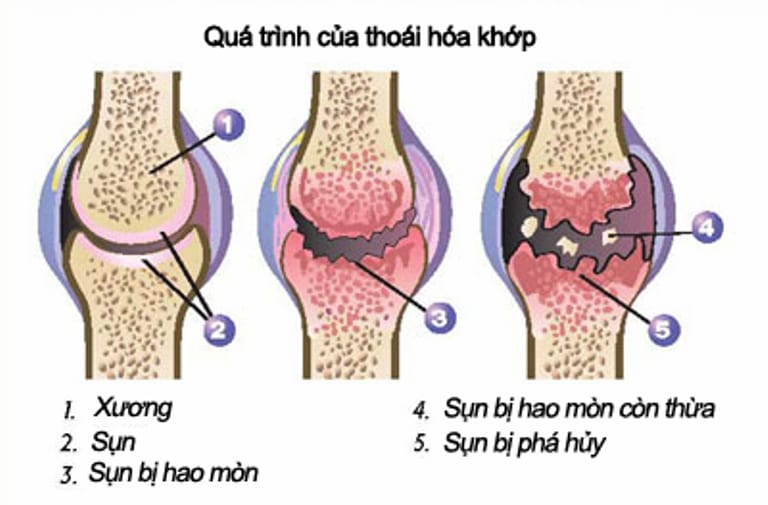 Thoái hóa khớp gối độ 2 - Nguyên nhân, triệu chứng và cách điều trị