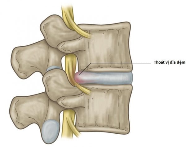  Những biểu hiện của căn bệnh thoát vị ở đĩa đệm