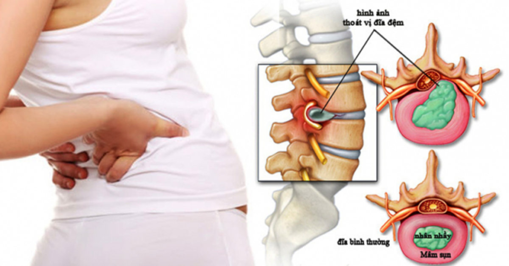 Thoát vị đĩa đệm - căn bệnh nguy hiểm khiến nhiều người khổ tâm