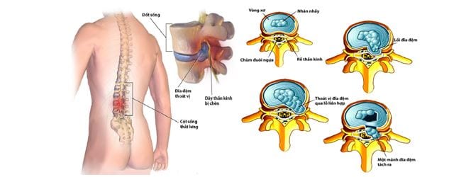  Hai phương pháp điều trị căn bệnh thoát vị ở đĩa đệm theo phương pháp đông y