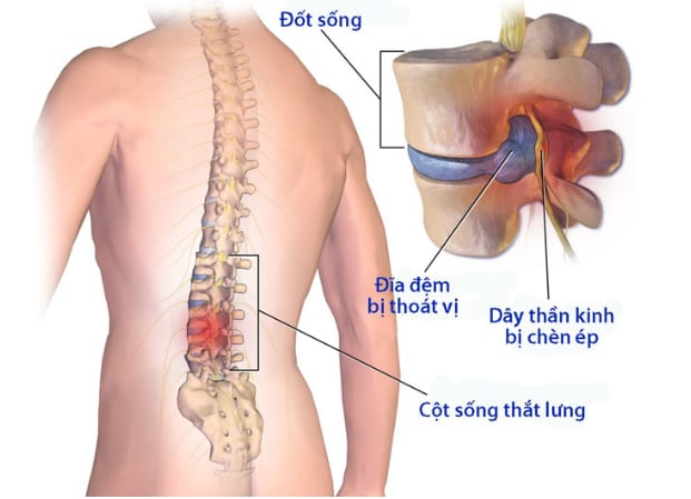  Phòng tránh thoát vị ở đĩa đệm không hề khó