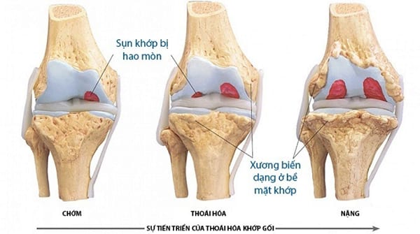 Thoái hóa khớp gối là căn bệnh gây ảnh hưởng không nhỏ đến sinh hoạt hàng ngày của mỗi người.